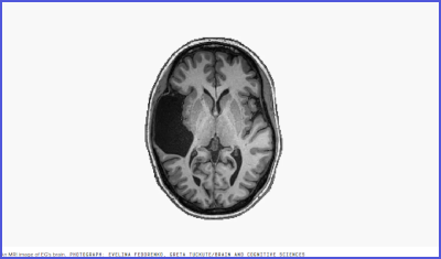 empty-lobe